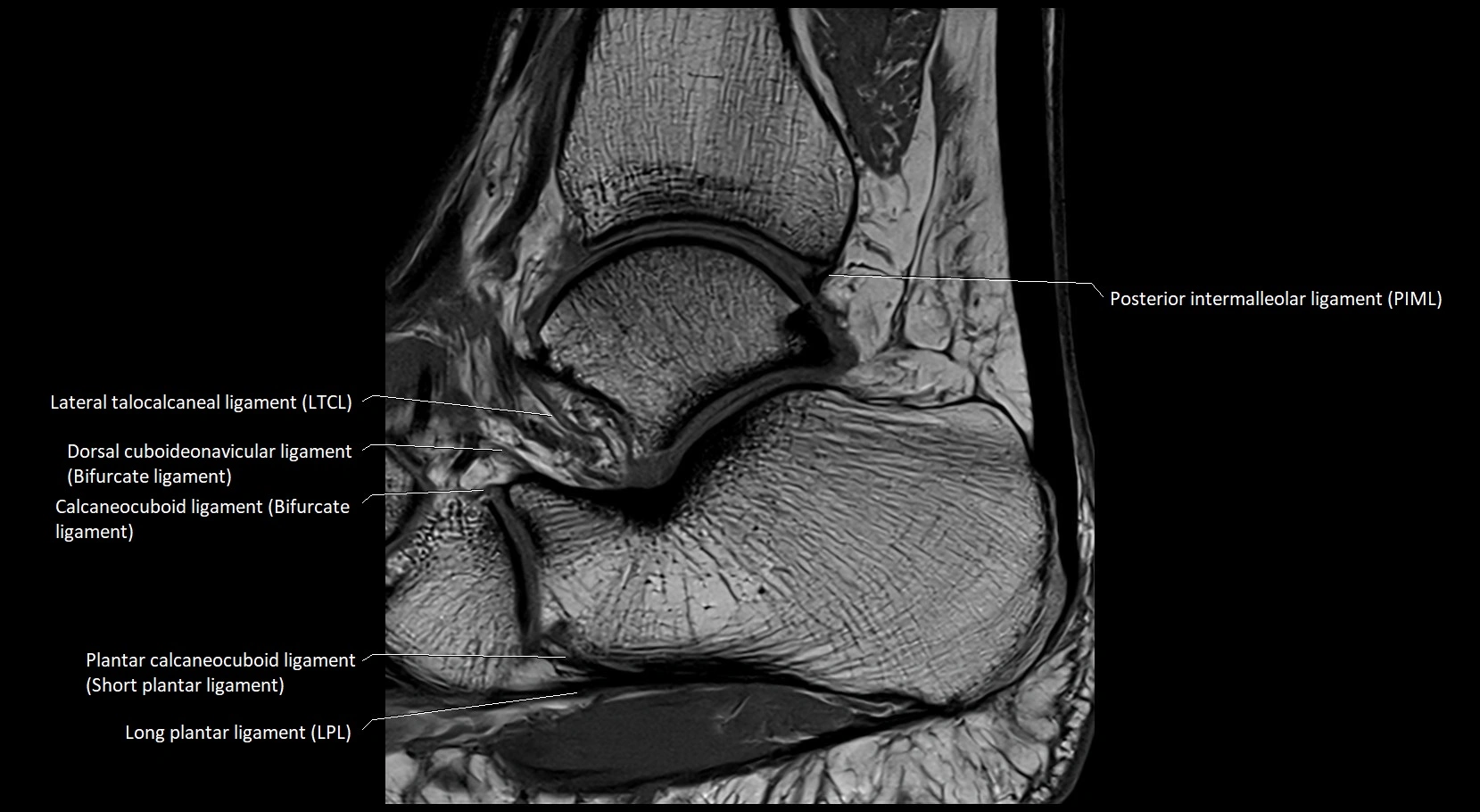 MRI ankle ligaments anatomy sagittal 3T image 17.webp